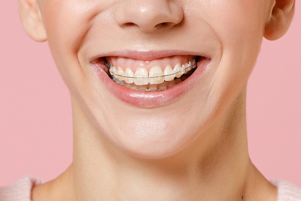 How To Keep Clear Braces From Yellowing