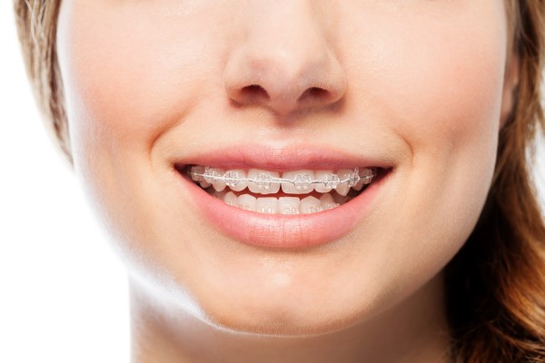 How To Take Care Of Your Teeth While You Have Clear Braces