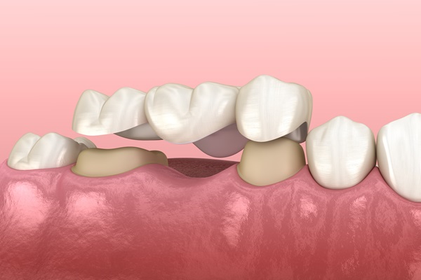 Benefits Of Dental Bridges