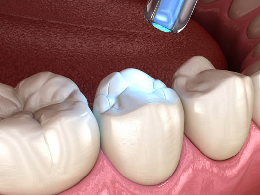 Dental Filling Options