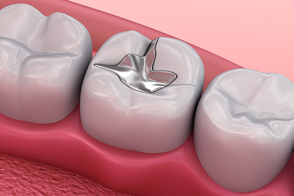 When Should You Replace An Old Dental Filling?