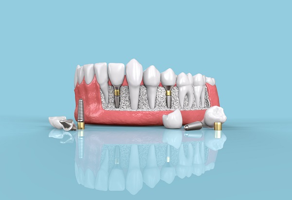 Dental Implants Austin, TX