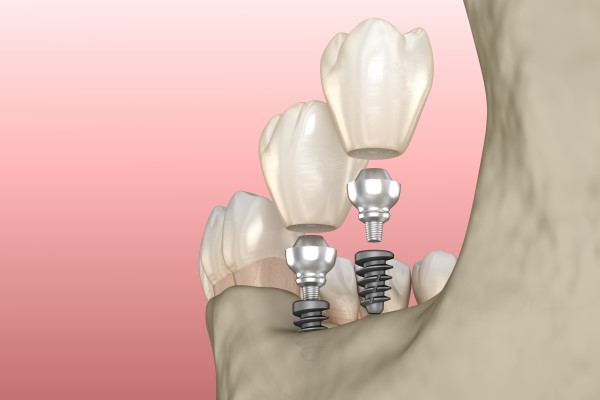 Can Dental Implants Replace Molar Teeth?
