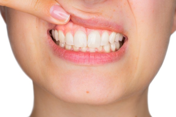 What Gum Disease Looks Like