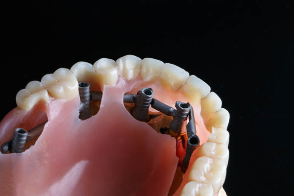 Implant Supported Dentures Austin, TX