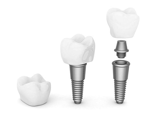 Why Our Patients In Austin Love Mini Dental Implants